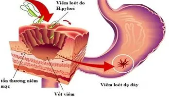 Đừng chủ quan trước biến chứng và tác hại của bệnh viêm loét dạ dày