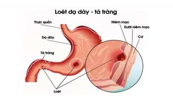 Nhận biết nhanh triệu chứng của bệnh viêm loét dạ dày