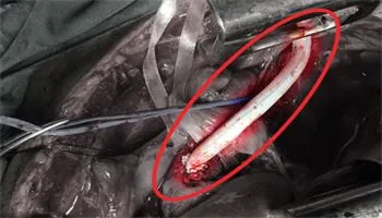 Bệnh nhân bị tổn thương mạch máu lồng ngực thoát chết trong gang tấc