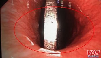 Một trẻ xém mất mạng vì nuốt đồng xu