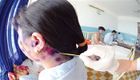 Bệnh thủy đậu (phỏng dạ) ở người lớn không thể xem thường