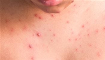 Bị thủy đậu rồi có bị lại không?