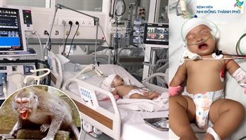 Bé gái 14 tháng bị khỉ tấn công chấn thương sọ não