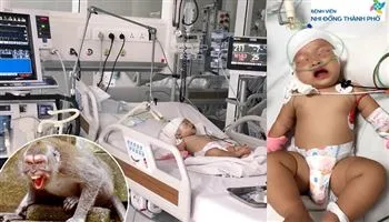 Bé gái 14 tháng bị khỉ tấn công chấn thương sọ não