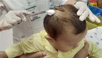 Bé gái bị khỉ cắn lún sọ đã xuất viện