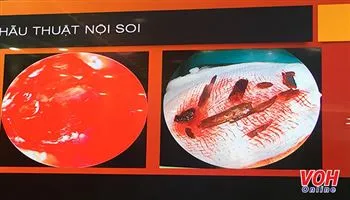 Gắp 10 dị vật nằm sau nhãn cầu cực hiếm gặp