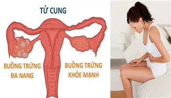 Bệnh đa nang buồng trứng có mang thai được không ?