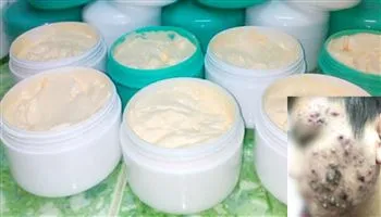 Hóa gương mặt quỷ sau khi sử dụng kem trộn trị mụn trứng cá