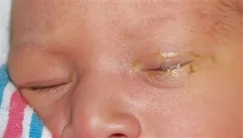 Nguyên nhân mắt trẻ sơ sinh bị ghèn nhiều và cách chăm sóc