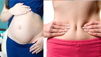 Bí quyết giảm mỡ bụng sau sinh mổ cực hiệu quả và an toàn