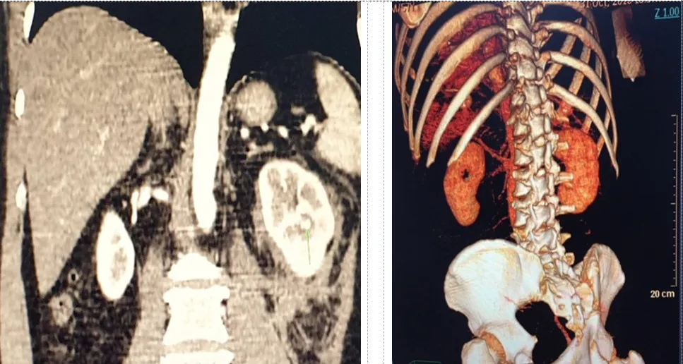 Hình chụp CT scanner: vết thương thận trái