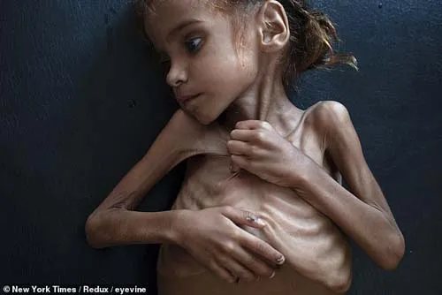 WPF tăng gấp đôi viện trợ lương thực cho Yemen trước nguy cơ 14 triệu người phải chết đói