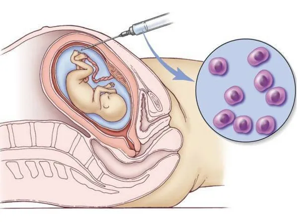 Chọc ối – Xét nghiệm giúp phát hiện sớm những bất thường ở thai nhi 1
