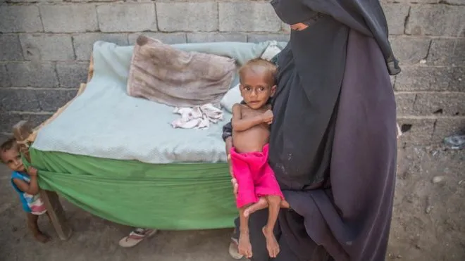 Tin nóng ngày 21/11/2018: 85.000 trẻ em tử vong vì suy dinh dưỡng tại Yemen