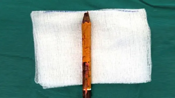 Bị bút chì đâm xuyên mông, tai nạn hy hữu tại trường học          