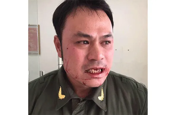 Anh Nguyễn Văn Điệp - nhân viên an ninh hàng không sân bay Nội Bài bị hành hung, đánh gãy răng