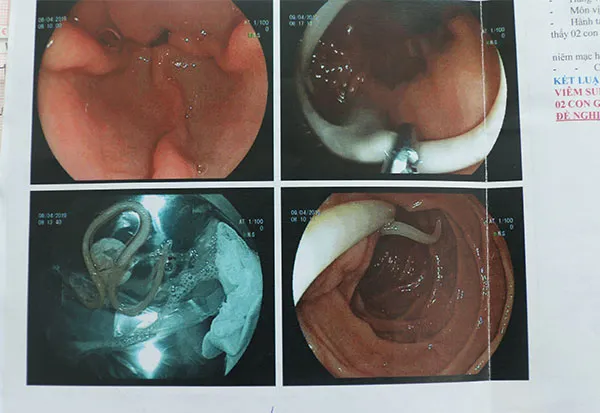 Hình ảnh qua nội soi phát hiện giun nằm trong dạ dày tá tràng 