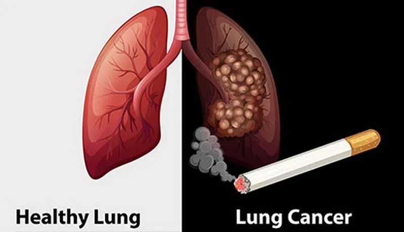 WHO nhấn mạnh quy mô lớn của các ca tử vong do bệnh phổi liên quan đến thuốc lá