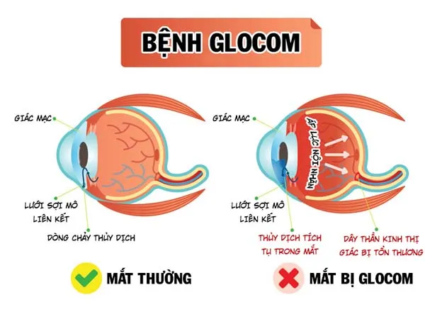 nhung-doi-tuong-de-mac-benh-glocom-voh-1