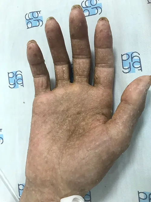 Bàn tay nhiễm độc thạch tín của người bệnh
