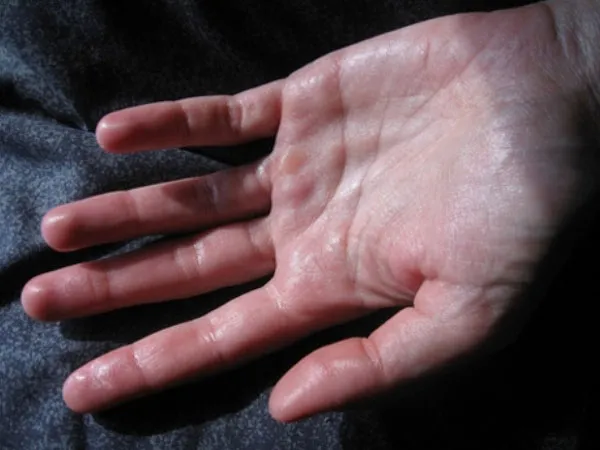 Nguyên nhân và cách khắc phục chứng ra mồ hôi tay chân 1