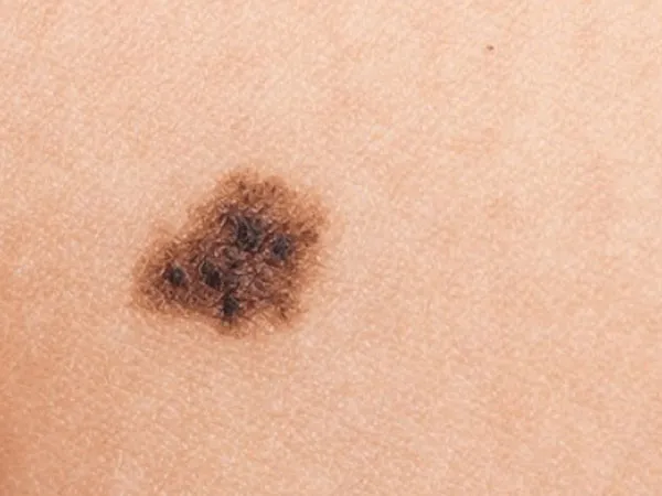 melanoma-la-gi-benh-nay-co-chua-duoc-khong-voh