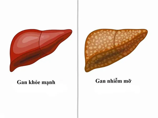 gan-nhiem-mo-nhe-co-can-dieu-tri-khong-voh