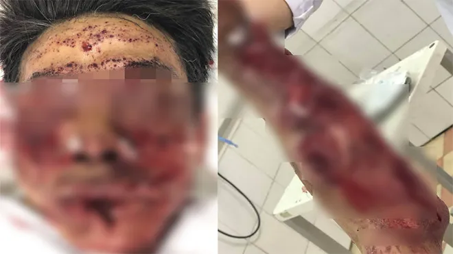 Phần mặt và cánh tay của ông K (44 tuổi, Hà Nam). bị dập, nát, chấn thương sau khi bị pháo nổ. Ảnh Bệnh viện cung cấp