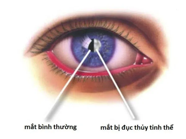 3-loai-trai-cay-cuc-tot-cho-nguoi-bi-benh-cuom-mat-voh