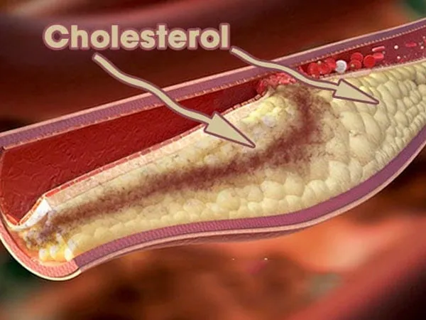 cholesterol-co-that-su-xau-doi-voi-co-the-1-voh