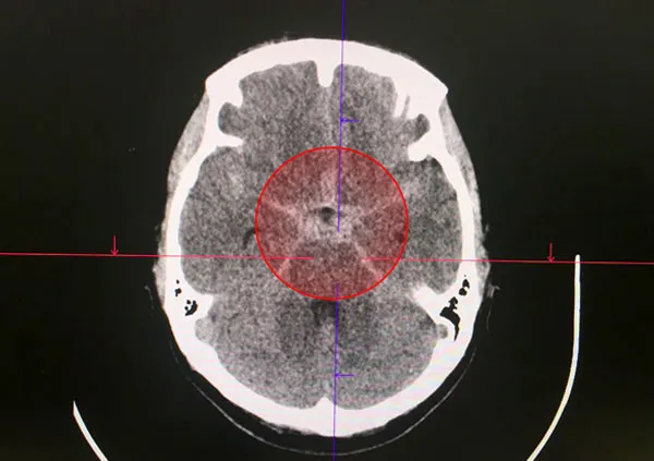 Kịp thời cứu bệnh nhân trẻ bị xuất huyết do vỡ túi phình động mạch não