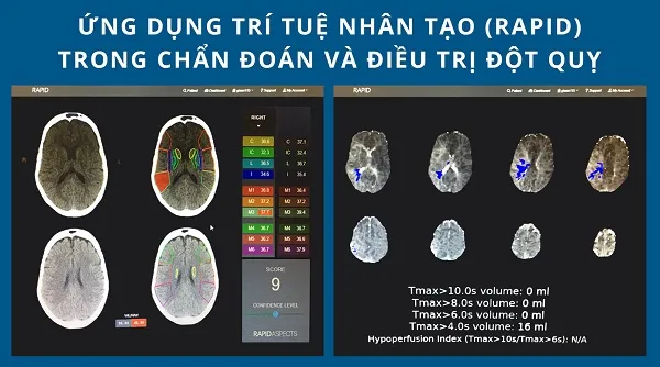 đột quỵ não cấp, bệnh viện Gia An, ngày 2 tháng 10 năm 2020