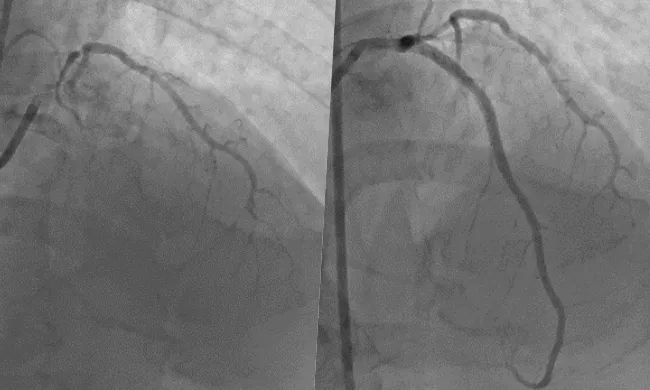 Cứu sống bệnh nhân nhồi máu cơ tim cấp bằng đặt stent mạch vành 2