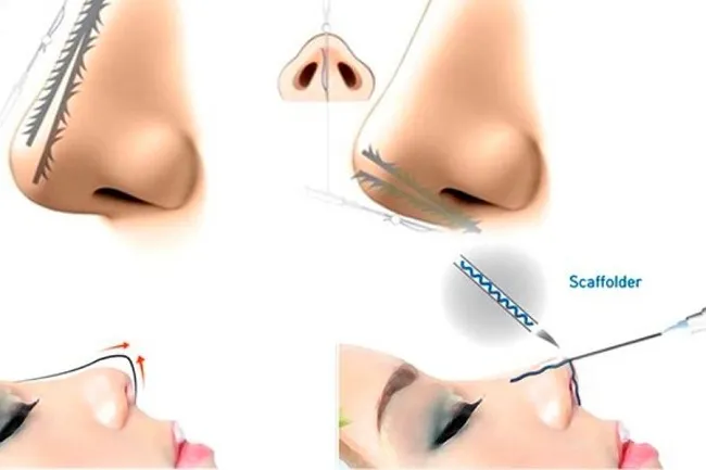 Các phương pháp nâng mũi mới và phổ biến hiện nay 2