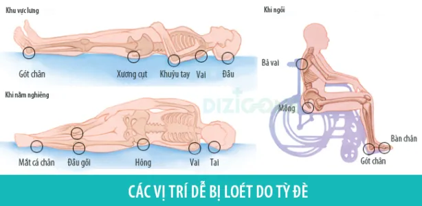 Các vị trí dễ bị loét tì đè