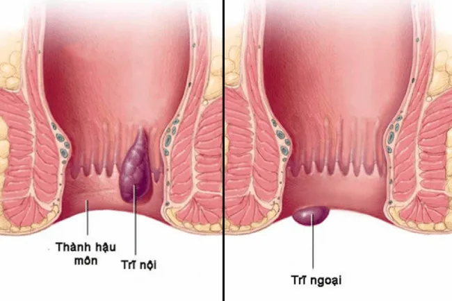 Cách phân biệt trĩ nội và trĩ ngoại đơn giản tại nhà 1