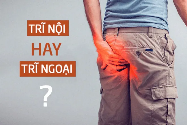 Cách phân biệt trĩ nội và trĩ ngoại đơn giản tại nhà 2