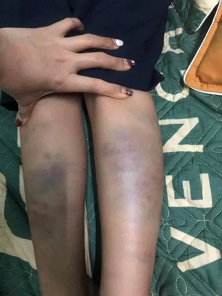 Xác minh vụ học sinh lớp 1 ở Đà Nẵng bị bầm tím tay chân 1