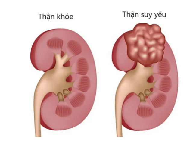 Thận yếu có ảnh hưởng đến chất lượng tinh trùng của nam giới không? 1