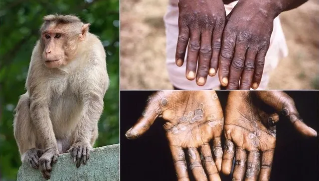 Đậu mùa khỉ được Bộ Y tế xếp vào nhóm B các bệnh truyền nhiễm nguy hiểm 1