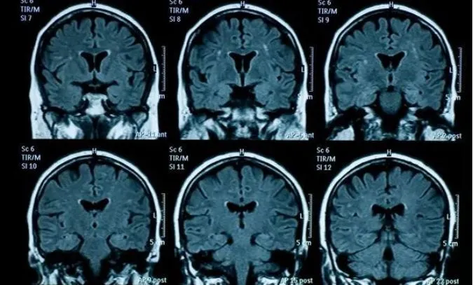 Não bộ thanh thiếu niên có dấu hiệu lão hóa nhanh hơn sau đại dịch COVID-19 1