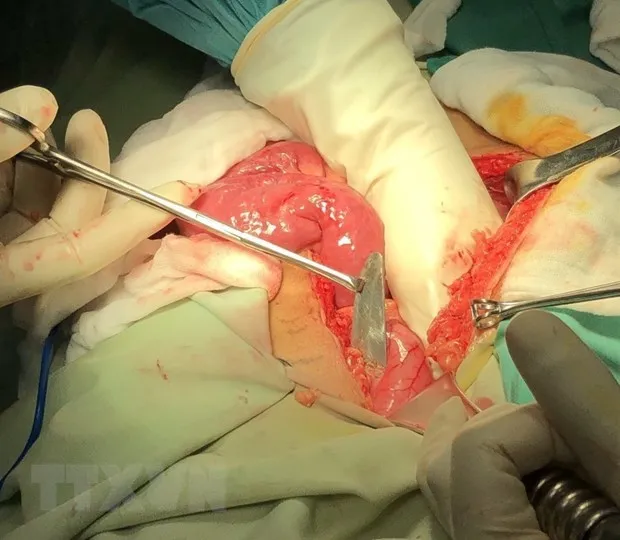 Phẫu thuật lấy lưỡi dao 10cm trong bụng cứu sống bệnh nhân 1