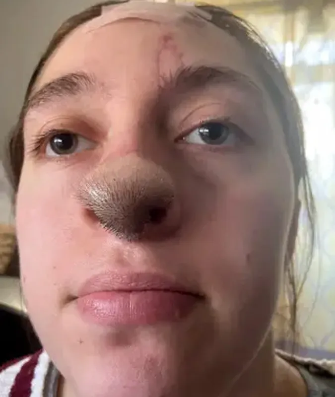 Cô gái mọc đầy lông trên mặt sau khi bị chó cắn đứt mũi 2