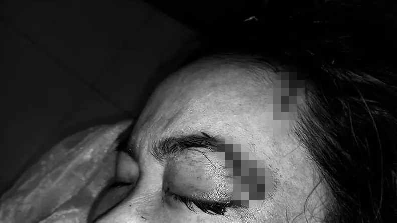 Hình ảnh mắt của bệnh nhân sau khi bị chó cắn.