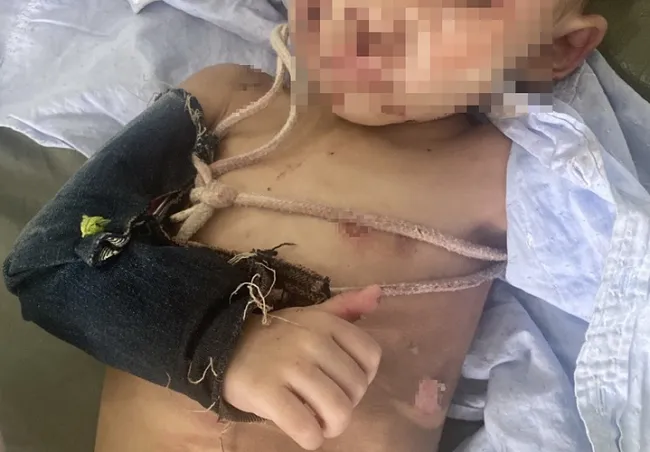 Hóc Môn: Công an xác minh bé trai bị gãy tay, nhiều vết thương trên người 1