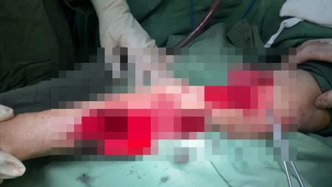 Người phụ nữ bị chó nhà nuôi cắn trọng thương 1