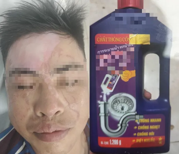Nổ lớn khi thông cống, một người bỏng nặng 1