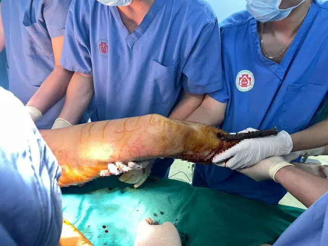 Cấp cứu kịp thời nam thanh niên ngã từ tầng 5 xuống cọc bê tông 1