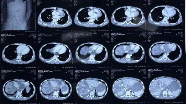 Hình ảnh X-quang cho thấy lá gan của bệnh nhi bị vỡ, phổi giập hai bên - Ảnh: Bệnh viện cung cấp