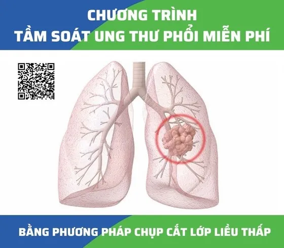 Bệnh viện Ung bướu TPHCM Khám, tầm soát ung thư phổi miễn phí 1